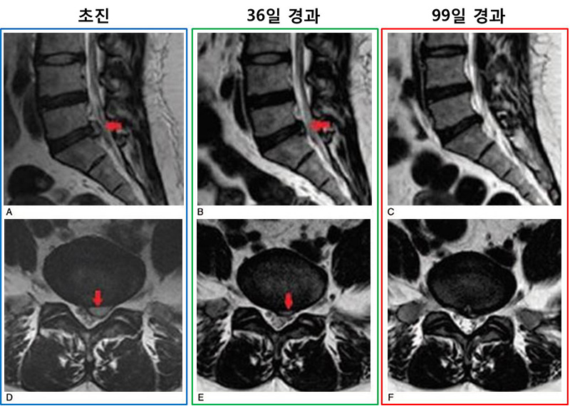 [사진설명] 초진 당시 뚜렷하게 보인 디스크 낭종이 치료 1개월부터 유의미하게 작아졌고 3개월에 이르러서는 완전 흡수됐다