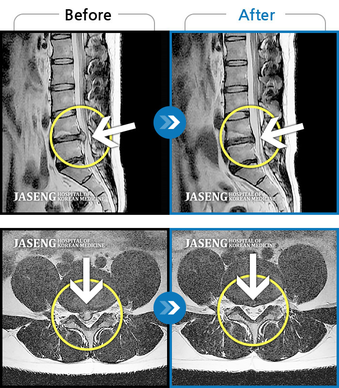 자생한방병원 치료사례 MRI로 보는 치료결과-허리 골반통증이 극심했다.