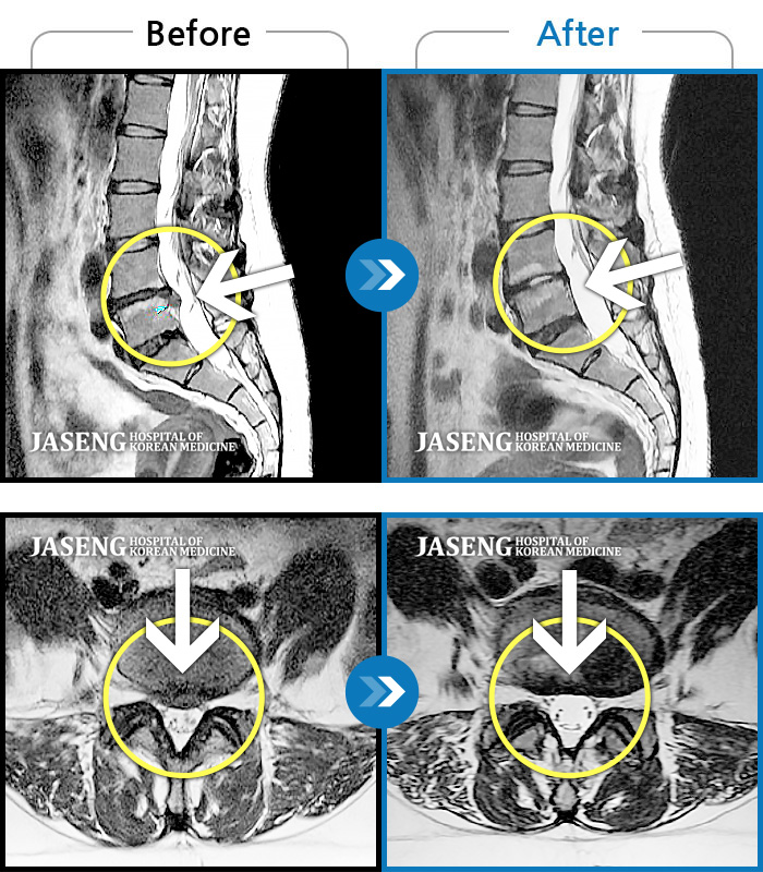 자생한방병원 치료사례 MRI로 보는 치료결과-허리와 우측 허벅지, 다리 바깥쪽으로 통증과 저림이 심했다. 