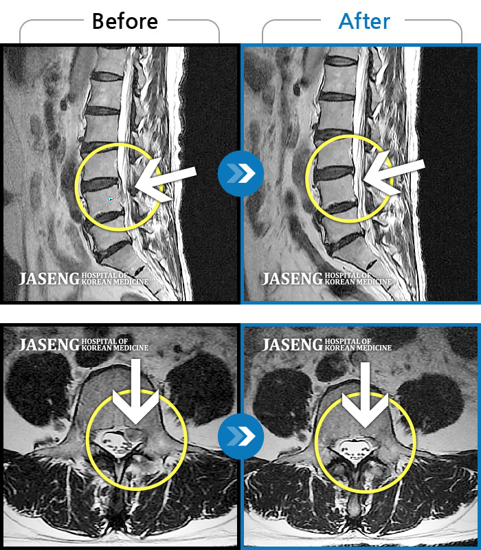 자생한방병원 치료사례 MRI로 보는 치료결과-우측 다리가 당겨서 걷기가 불편했다.