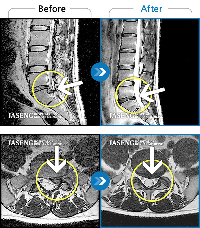 자생한방병원 치료사례 MRI로 보는 치료결과-요부 통증 및 좌측 하지 통증이 심해서 걸을 수가 없다.