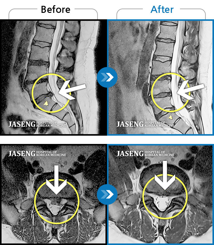 자생한방병원 치료사례 MRI로 보는 치료결과-좌측 허리부터 좌측 골반까지 찌릿하고 묵직한 통증, 좌측 하지 후면으로 이어지는 저린감