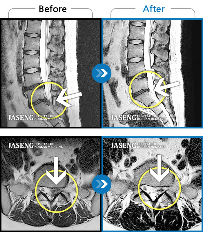 자생한방병원 치료사례 MRI로 보는 치료결과-허리와 좌측 다리 통증, 저림이 심해요. 