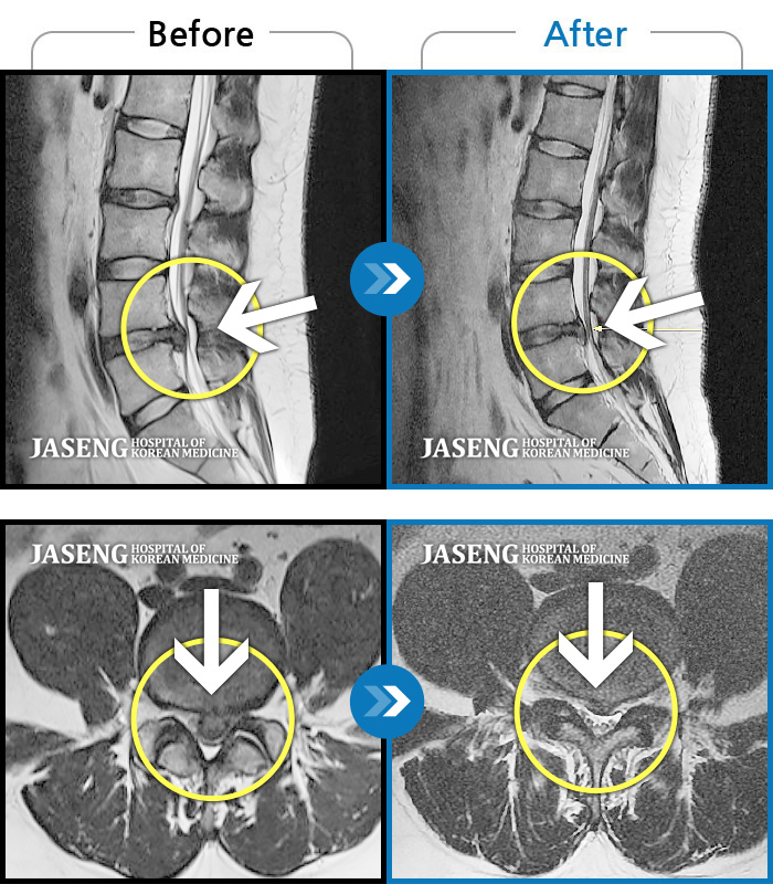 자생한방병원 치료사례 MRI로 보는 치료결과-되풀이되는 왼쪽 다리 야간통으로 인한 수면장애와 허리통증