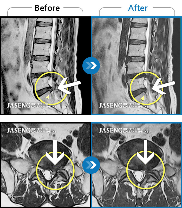 자생한방병원 치료사례 MRI로 보는 치료결과-좌측 허리부터 좌측 골반까지 통증, 좌측 하지 후면으로 이어지는 통증, 수면 시 욱신거리는증상 동반