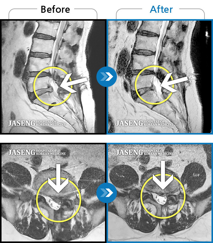 자생한방병원 치료사례 MRI로 보는 치료결과-허리가 욱신욱신하게 아프고 보행 시 왼쪽 골반, 허벅지, 종아리가 당겨서 걷기 어려움