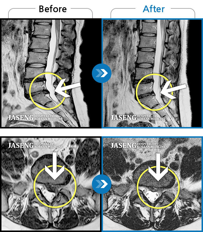 자생한방병원 치료사례 MRI로 보는 치료결과-일상생활이 힘들 정도의 허리 통증과 왼쪽 다리 통증