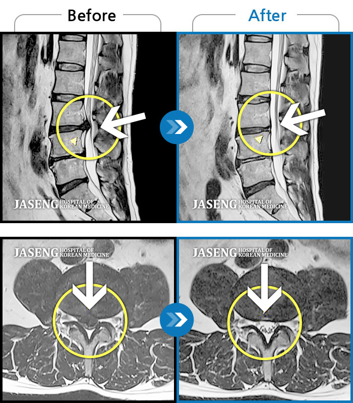 자생한방병원 치료사례 MRI로 보는 치료결과-양측 허리에 묵직한 통증과 양측 허벅지부터 종아리까지 하지 방사통