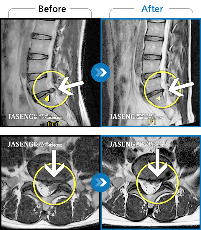 자생한방병원 치료사례 MRI로 보는 치료결과-허리부터 좌측 골반 통증, 좌측 허벅지부터 발등까지 찌릿한 저림 증상