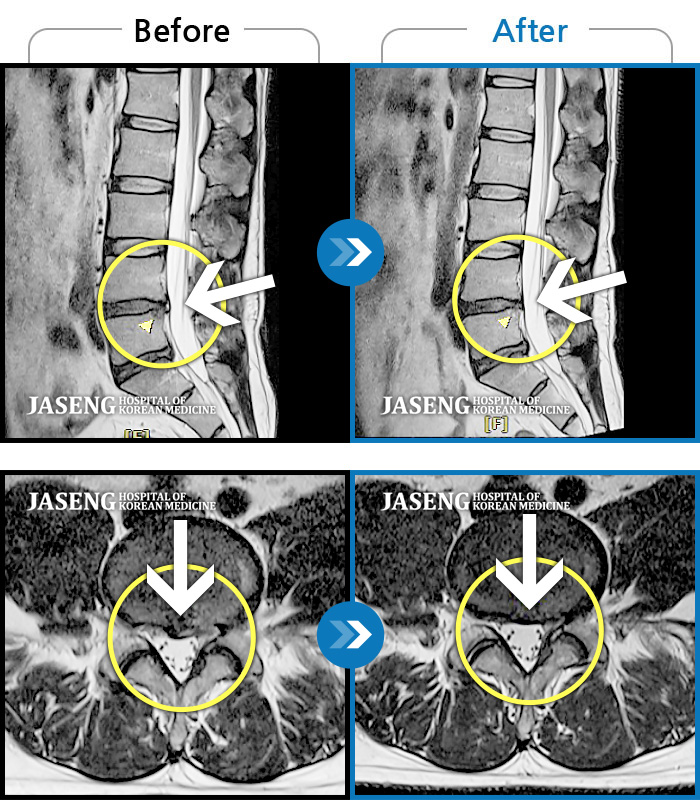 자생한방병원 치료사례 MRI로 보는 치료결과-양측 허리부터 골반 묵직한 통증, 좌측 다리 저리고 당기는 통증과 감각저하