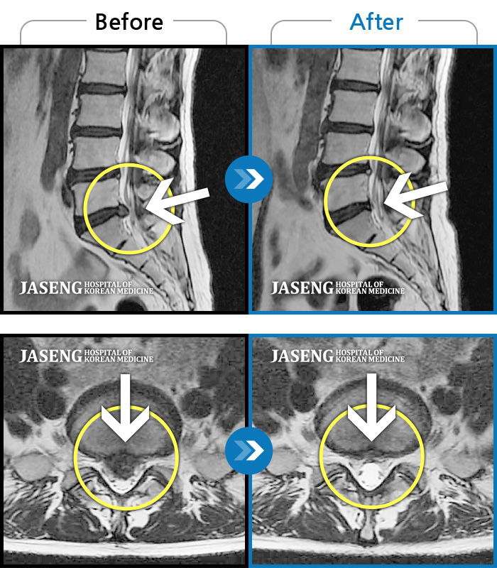 자생한방병원 치료사례 MRI로 보는 치료결과-왼쪽 허리에서 다리로 내려가는 심한 통증으로 서 있거나 오래 걷지 못하였습니다.