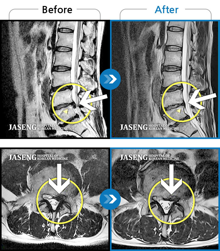 자생한방병원 치료사례 MRI로 보는 치료결과-양측 허리부터 양측 골반까지 뻐근한 통증, 좌측 하지 외측으로 이어지는 통증