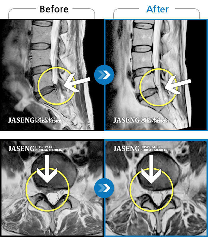자생한방병원 치료사례 MRI로 보는 치료결과-오른쪽 골반, 허벅지, 종아리가 당겨서 걷기 어려움