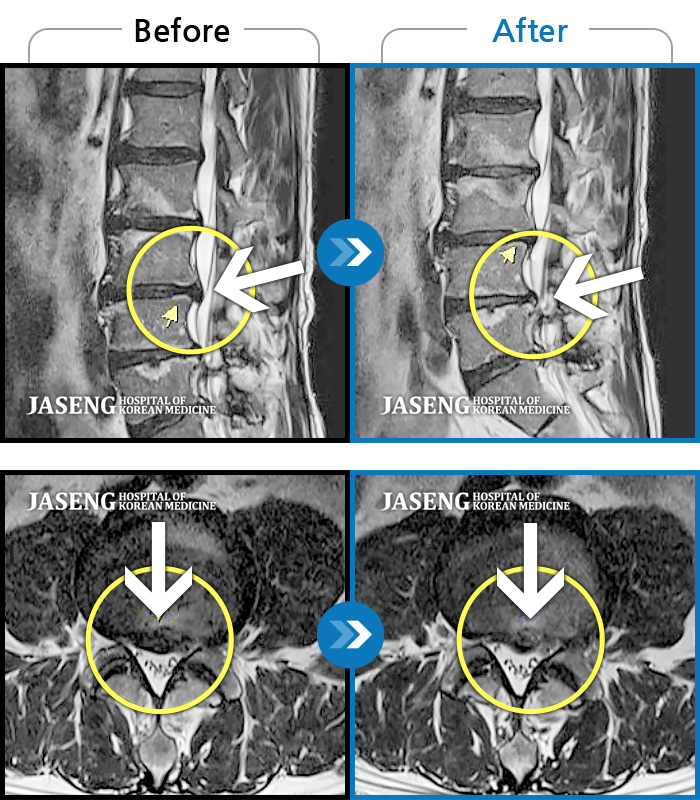 자생한방병원 치료사례 MRI로 보는 치료결과-양측 허리부터 양측 골반까지 통증, 앉았다 일어날때 통증 심화 