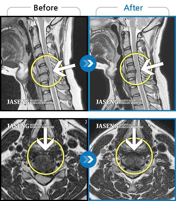 자생한방병원 치료사례 MRI로 보는 치료결과-좌측 상지의 저림 증상으로 내원