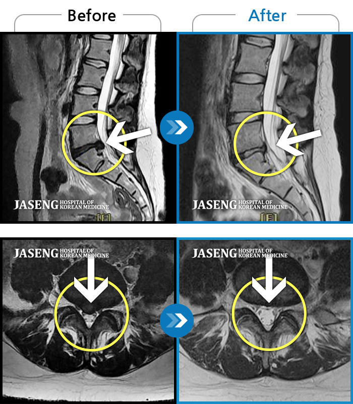 자생한방병원 치료사례 MRI로 보는 치료결과-양측 허리부터 양측 골반까지 묵직하고 찌릿한 통증, 우측 하지로 이어지는 저림감