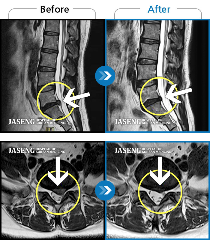자생한방병원 치료사례 MRI로 보는 치료결과-양측 허리부터 골반 통증, 좌측 종아리까지 이어지는 당김