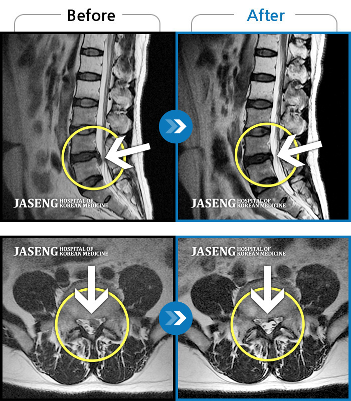 자생한방병원 치료사례 MRI로 보는 치료결과-허리통증, 좌측 다리 바깥쪽으로 저림이 있어서 양말을 신기도 어려워요. 