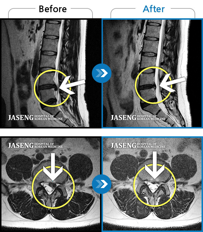 자생한방병원 치료사례 MRI로 보는 치료결과-좌측 허리부터 고관절 통증이 심하고 다리까지 저려서 허리를 똑바로 펴기 힘들어요. 