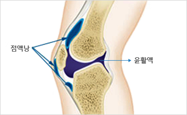 자생한방병원 무릎질환 무릎점액낭염-점액낭과 윤활액이 위치해 있는 무릎 설명 이미지