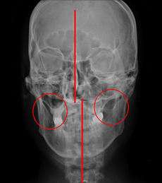 ϻڻѹ溴 ŸŬ ûҳô ΰ&ȸĪ- X-RAY ̹