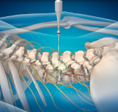 자생한방병원 허리치료법 신경근회복술-신경근회복술의 특징 두번째 관련 사진 입니다.