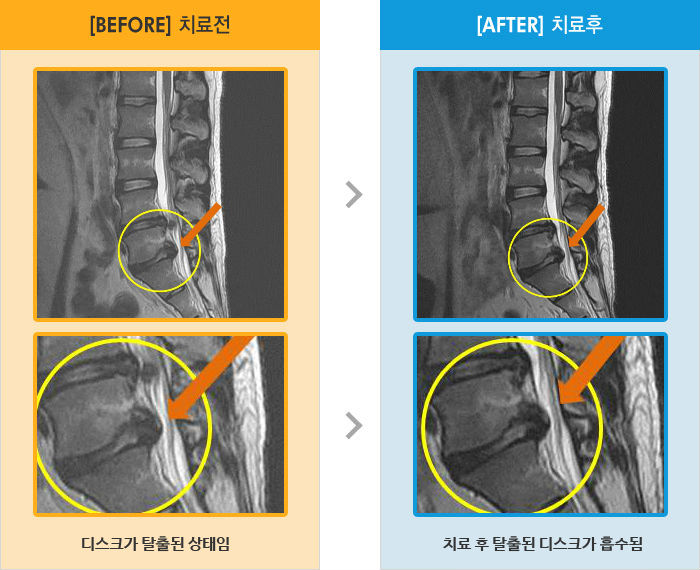 자생한방병원 치료사례 MRI로 보는 치료결과-일어서서 걸을때 왼쪽 엉덩이 무릎 발목 통증