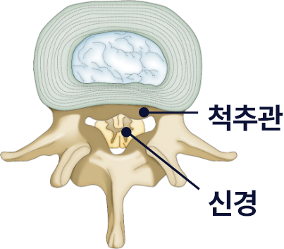 척추관협착증으로 척추관이 좁아져 신경을 압박하는 척추 단면도