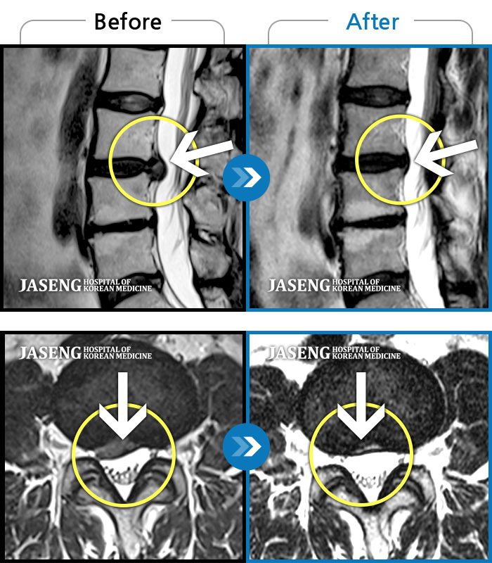 ڻѹ溴 ġ MRI ġ-㸮 Բ ߳ 1 ̻ Ǿ ֱ 1-2 ̿ ް ٸ ڰ