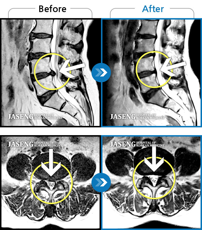 Ȼڻѹ溴 ġ MRI ġ-㸮 ϻ .