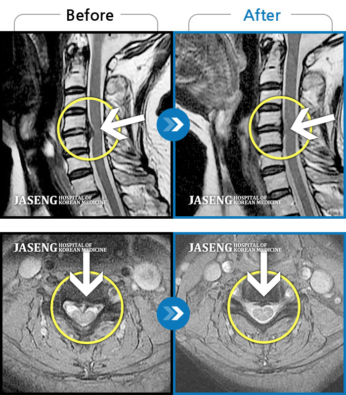 Ȼڻѹ溴 ġ MRI ġ- īӰ .