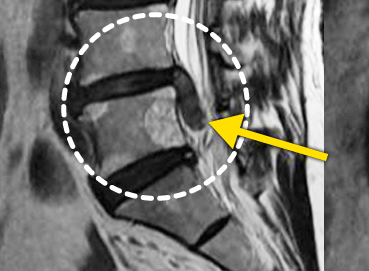 ڻġ  MRI  ׷ ̹ Դϴ.